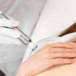 Лазерный пилинг