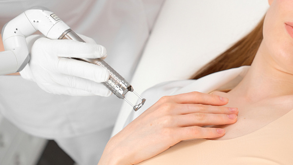 Лазерный пилинг