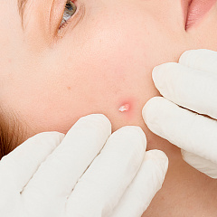 Удаление кожного рога