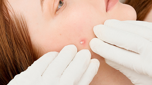 Удаление кожного рога