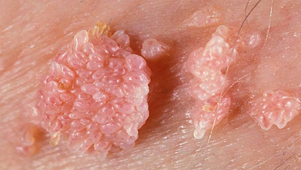 Лечение кондилом: удаление кондилом лазером