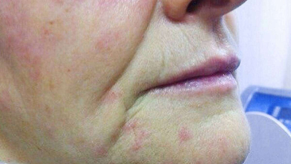 Удаление телеангиэктазий