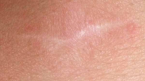 Удаление шрамов лазером SmartXide DOT на лице и шее