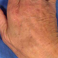 Удаление пигментных пятен лазером Fraxel