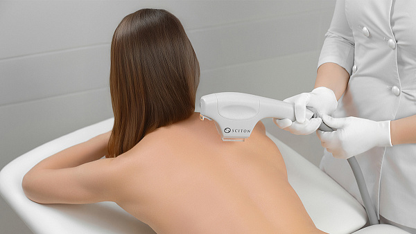 Лазерное удаление пигментных пятен