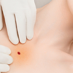 Лечение ботриомикомы (пиогенной гранулемы) на теле