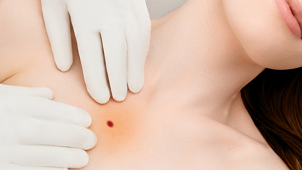 Лечение ботриомикомы (пиогенной гранулемы) на теле