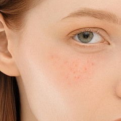 Удаление и лечение милиумов на лице и шее