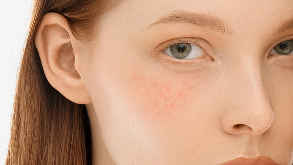 Удаление и лечение милиумов на лице и шее