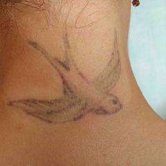 Удаление татуировок лазером Q-Switched Nd:YAG