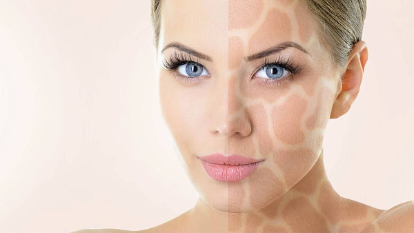 Лечение пигментации Laser Toning