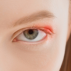 Лечение халязиона верхнего и нижнего века: удаление лазером