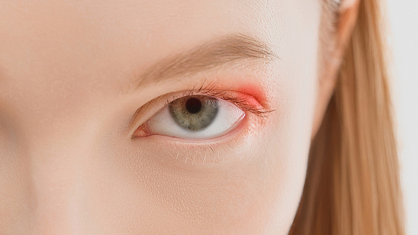 Лечение халязиона верхнего и нижнего века: удаление лазером