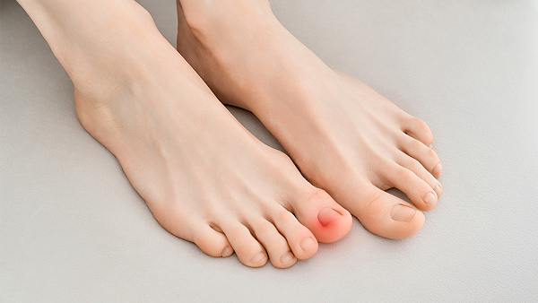 Удаление вросшего ногтя