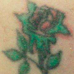 Удаление цветных татуировок на теле лазером SPECTRA