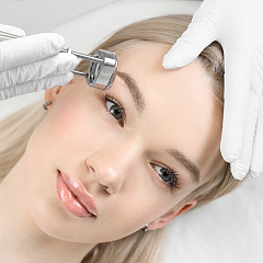 Лазерная эпиляция бровей и межбровья