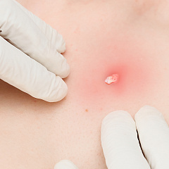 Удаление кожного рога на теле