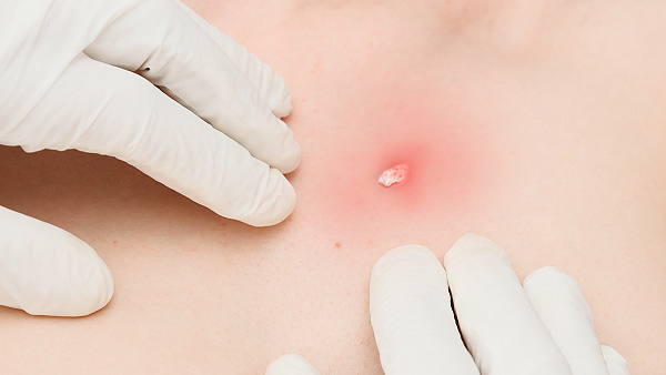 Удаление кожного рога на теле