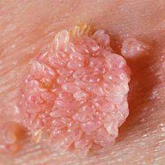 Лечение кондилом: удаление кондилом лазером