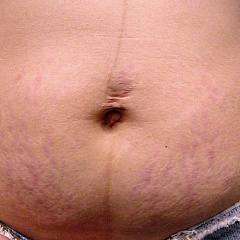 Удаление растяжек на теле лазером Fraxel