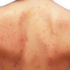 Лечение пигментации на теле Laser Toning