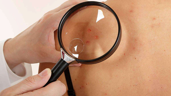 Карбоновый пилинг