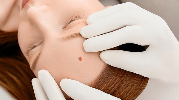 Удаление кератомы на лице