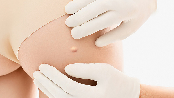 Лечение атеромы: удаление атеромы (жировика) на теле лазером