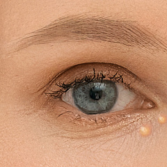 Удаление ксантелазмы с лица и шеи