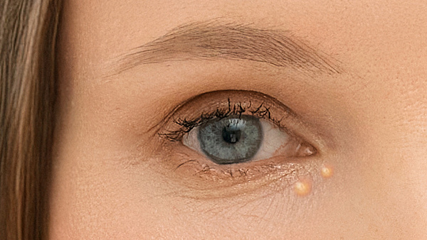 Удаление ксантелазмы с лица и шеи