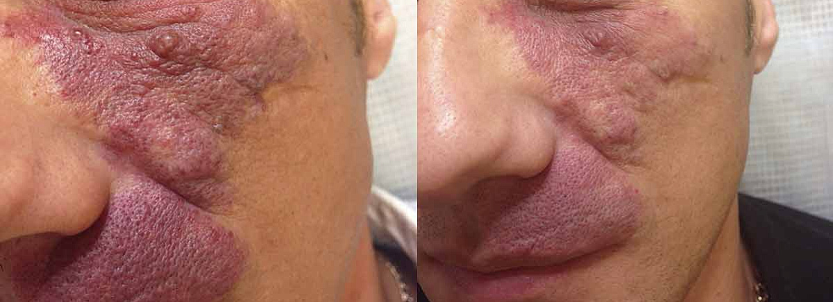 Удаление гемангиомы