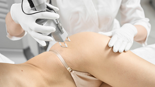 Лазерное удаление растяжек