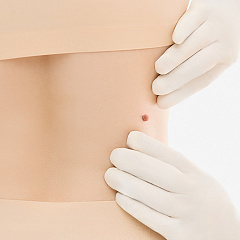 Удаление папиллом лазером, лечение папиллом на теле