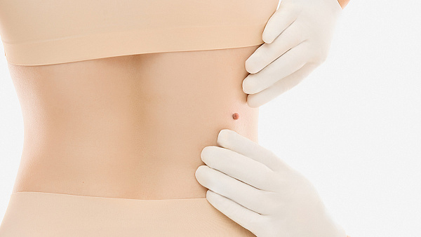 Удаление папиллом лазером, лечение папиллом на теле