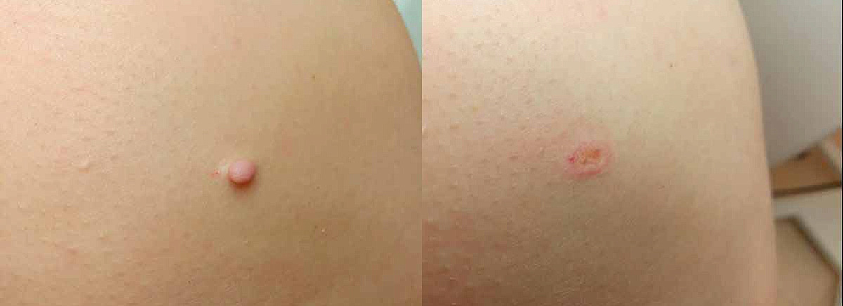 Удаление фибромы