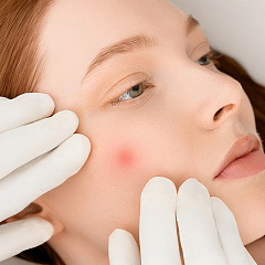 Лечение фибромы кожи - удаление лазером