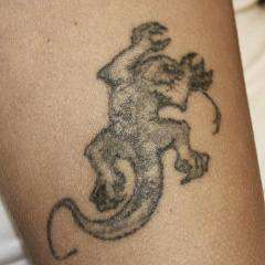 Удаление татуировок неодимовым лазером Q-Switched ND:Yag