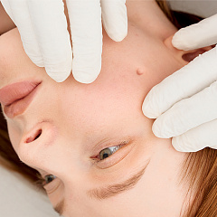 Удаление бородавок лазером, лечение бородавок