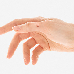 Удаление бородавок лазером, лечение бородавок на теле