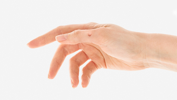 Удаление бородавок лазером, лечение бородавок на теле