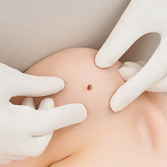 Удаление родинок лазером на теле без шрамов