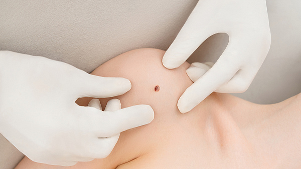 Удаление родинок лазером на теле без шрамов