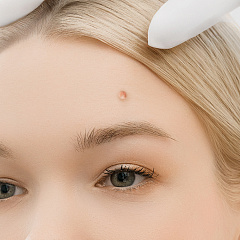 Удаление папиллом лазером, лечение папиллом