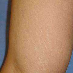 Удаление растяжек на теле лазером SmartXide DOT