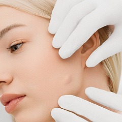 Лечение атеромы (удаление атеромы лазером)